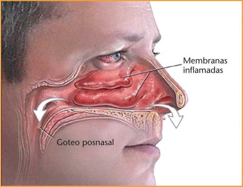 Causas y síntomas de la Congestión Nasal