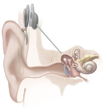 Alternativas de audición