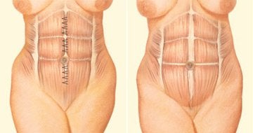 Cirugía de abdomen: así se pueden retensan los músculos abdominales
