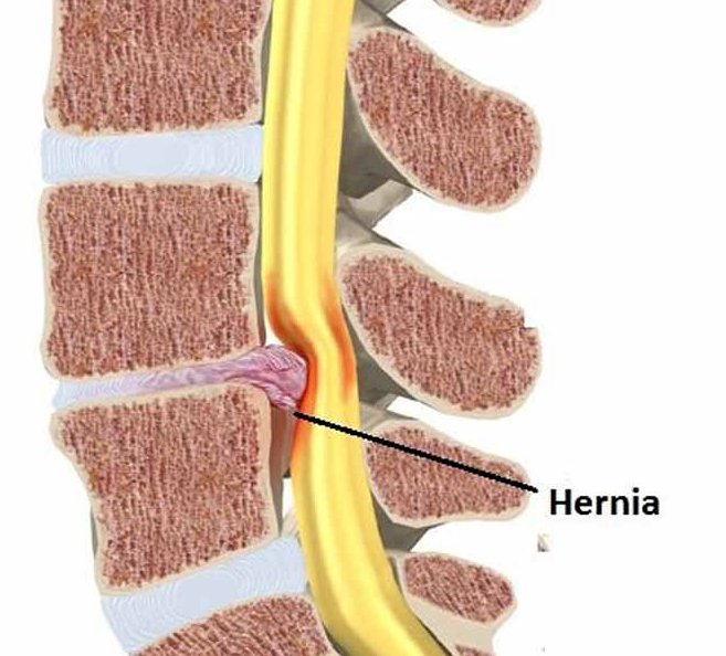 Tratamientos Hernia Discal
