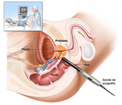 Braquiterapia Prostática mediante Implante de Semillas