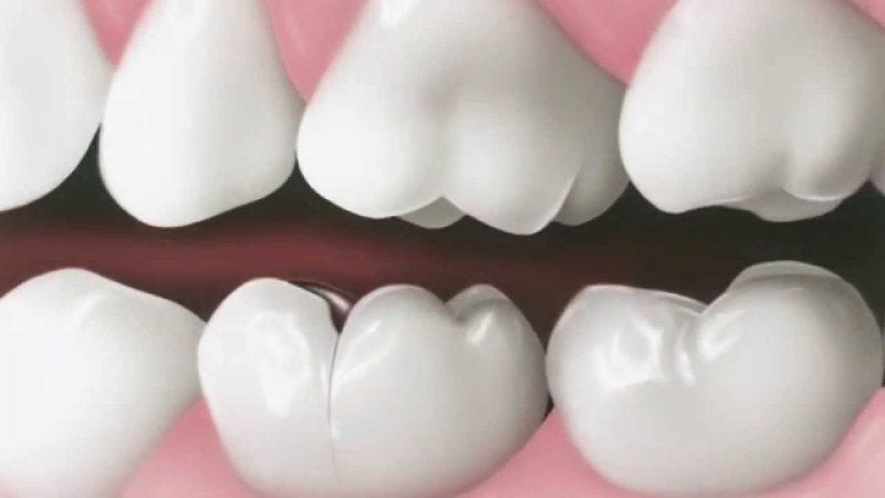 Sellado de Fisuras Dentales 