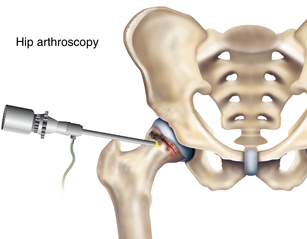 Artroscopia de Cadera