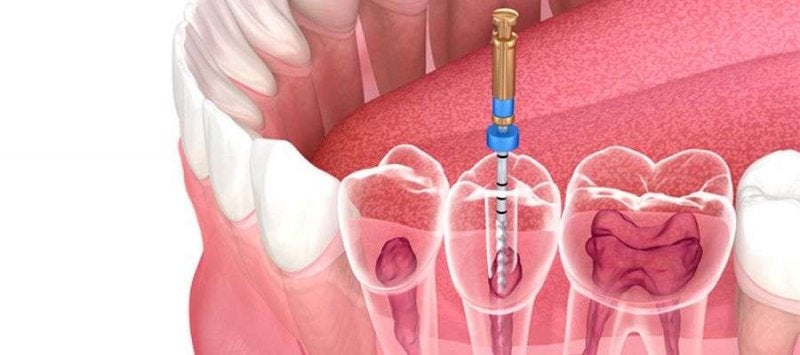 endodoncia