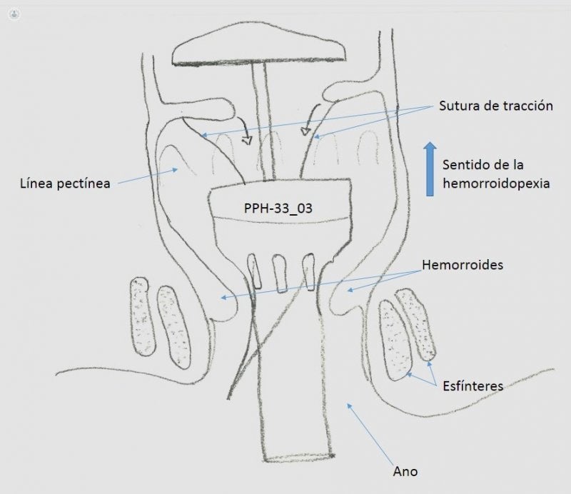 Mustectomía