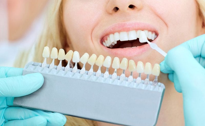 Causas y tipos de blaqueamiento dental