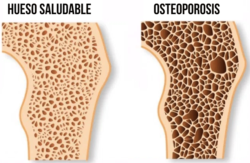 La osteoporosis provoca porosidad en los huesos