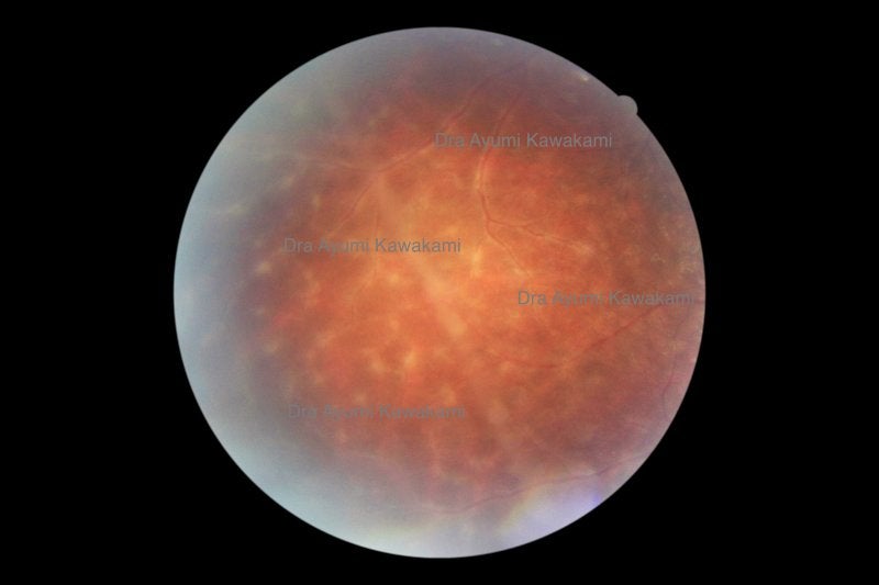 tratamiento sifilis ocular