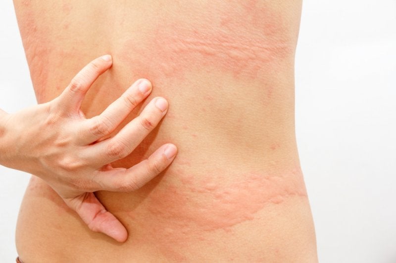 Alergias en la Piel qué es síntomas y tratamiento Top Doctors
