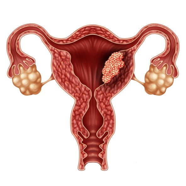pólipos-endometriales