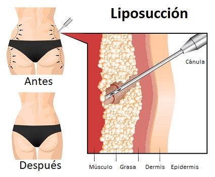 Liposucción