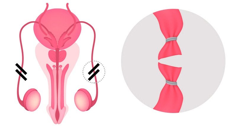 Vasectomía