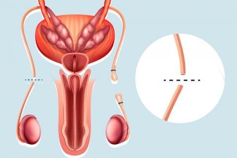 vasectomia-sin-bisturi