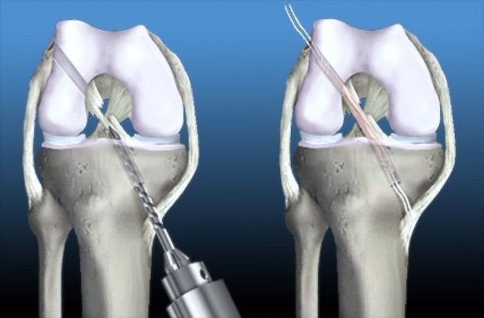 Rotura de ligamento cruzado anterior - Operación y tratamiento